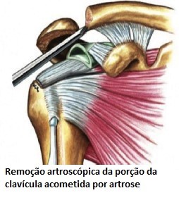 Artroza claviculară, Osteoartrita articulatiei acromio-claviculare